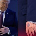 La Verdad detrás del Moretón que Azota a la Casa Blanca: Trump sufre Un MISTERIOSO Incidente en la Vida Pública
