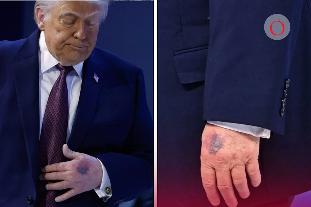 La Verdad detrás del Moretón que Azota a la Casa Blanca: Trump sufre Un MISTERIOSO Incidente en la Vida Pública