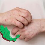 Gobierno dejó de gastar 70 % de recursos destinados a vacunas incluidas para Sarampión : PAN